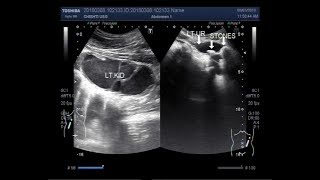 Ultrasound Video showing severe Pyonephrosis due to ureteric stones [upl. by Ynnahc]