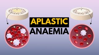 Aplastic Anaemia Causes Signs and Symptoms Diagnosis and Treatment [upl. by Denae]