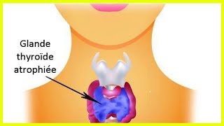 L’hypothyroïdie  comment prendre soin de sa thyroïde [upl. by Hollington]