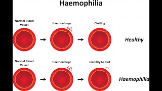 Hemophilia A An inherited Bleeding Disorder Mutations [upl. by Ennairoc105]