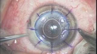 Deep Lamellar Keratoplasty  Big bubble technique [upl. by Aedrahs420]