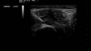 Punción de hombro guiada por ultrasonido [upl. by Isoais]