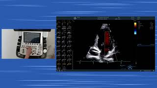 〖Echocardiography〗 Apical views handson  Color MMode diastolic dysfunction amp the RV TAPSE S [upl. by Tnerual]