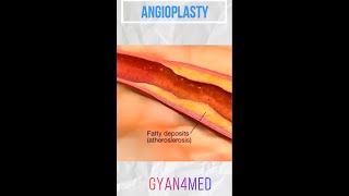 Coronary angioplasty Femoral Access [upl. by Chappell237]