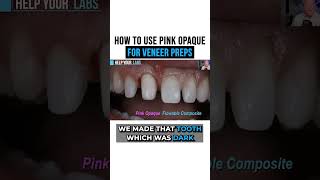 How To Use Pink Opaque For Veneer Preps [upl. by Eisinger]