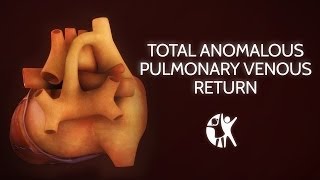 Total Anomalous Pulmonary Venous Return [upl. by Yk927]