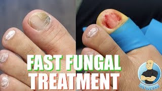 THE FASTEST WAY TO TREAT TOENAIL FUNGUS [upl. by Yonit158]