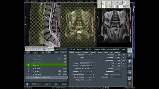 MRI Lumbar spine complete procedure Positioning Protocol Filming in Urdu and Hindi [upl. by Augy]