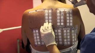 Skin Allergy Testing Using Patch Tests [upl. by Airdnal]