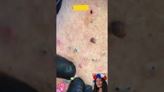 💙 Best Satisfying Blackhead Removal  Pimple Popping Blackheads amp White Heads Removal From Nose [upl. by Tatum684]