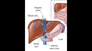 Budd Chiari Hepatic Vein Thrombosis Most Important Points [upl. by Lotus122]