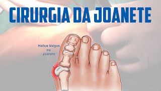 Como funcionar a cirurgia da joanete  Tratamentos tipos de cirurgias recuperação e outras duvidas [upl. by Ahsael]