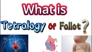 Tetralogy of fallot [upl. by Auoh]