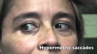 Case Challenge The patient had hypermetric saccades Video 1 [upl. by Ydnil]