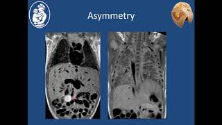 Heterotaxy Syndromes  Stephen Sanders MD [upl. by Nirat]