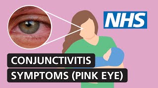 Conjunctivitis symptoms and treatment for red itchy watery eyes  NHS [upl. by Ernst865]