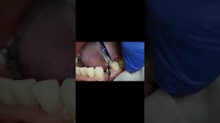 Lower first premolar implant percussion test after 6 month shorts [upl. by Euhsoj]