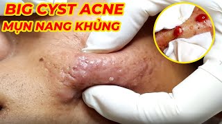 Điều trị mụn nang hiệu quả tại TPHCM  Cyst Acne Treatment  Hiền Vân spa Đỗ Thu Hiền  662 [upl. by Lamphere]