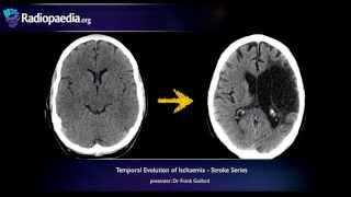 Stroke Evolution from acute to chronic infarction  radiology video tutorial CT MRI [upl. by Bethanne]