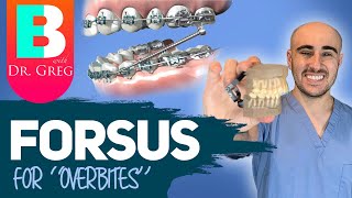 Braces Forsus for Overbite Overjet Correction [upl. by Ademordna784]