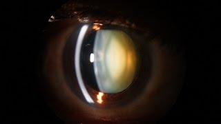 Slit Lamp examination of the anterior segment of the eye [upl. by Schroer]