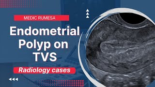 Endometrial Polyp on Transvaginal ultrasound  Radiology case 6 [upl. by Pilif]