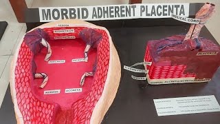 Morbidly Adherent Placenta Accreta Increta amp Percreta [upl. by Anam251]