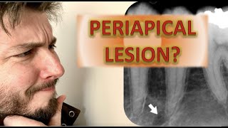 How to Identify a Periapical Radiolucency Abscess Cyst Granuloma Root canal infection x rays [upl. by Westlund158]