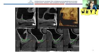 Benefits and risks in the diagnosis and planning of implantological treatment based on CBCT [upl. by Rezzani]