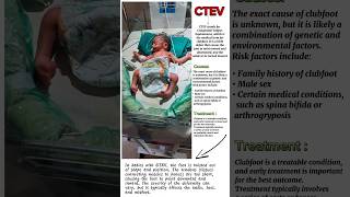 CTEV disease ❌🔥  Congenital Talipes Equinovarus🤕😖  hospital newbornbaby treatment motivation [upl. by Nosnej]