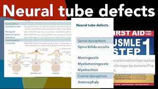 Neural tube defects Spina bifida occulta Meningocele Myelomeningocele Myeloschisis Anencephaly [upl. by Genny941]