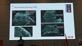 video6 Plasenta accreta spectrum [upl. by Bac]