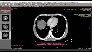 BuddChiari syndrome [upl. by Herrington]