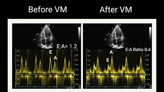 All about LV Diastolic Dysfunction Echocardiography Basics [upl. by Maisel]