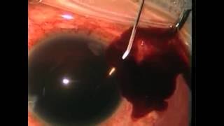 ac hyphema washout [upl. by Reema]