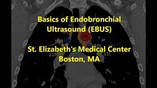 EBUS Basics and Mediastinal Staging  BAVLS [upl. by Kristel413]