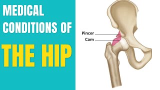 Conditions of the Hip Joint  Where the Pain is the Problem is not  John Gibbons [upl. by Sinne]