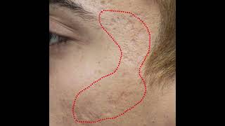 Acne Scar Treatment [upl. by Zehe]