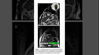 Identificación de Fibrosis Miocárdica en Resonancia Magnética [upl. by Cordle144]