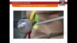 ligamentoplastie cheville arthroscopique type Brostrom Dr Guillo [upl. by Hartwell382]