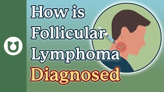 How is follicular lymphoma diagnosed follicularlymphoma [upl. by Etiragram712]