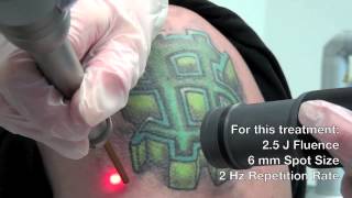 QSwitched Ruby Laser  Astanza Eternity Tattoo Removal Laser [upl. by Eseerehs]