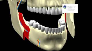 PROGNATISMO MANDIBULAR  OSTEOTOMIA SAGITAL [upl. by Dorotea83]