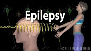 Epilepsy Types of seizures Symptoms Pathophysiology Causes and Treatments Animation [upl. by Nagirrek576]