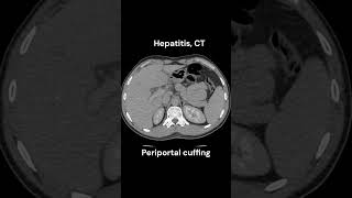 Hepatitis CT imaging radiology liver infection emergency [upl. by Secnarf]