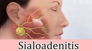 Sialoadenitis inflamación sublingual granos rojos tratamiento [upl. by Solis189]