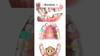 Second premolars extraction orthodontie kieferorthopädie orthodontics ortodonzia ortodoncia [upl. by Gnet]