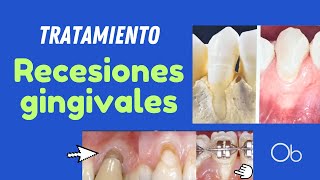 RECESIONES GINGIVALES causas y tratamiento encías retraídas [upl. by Eerised27]