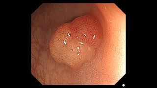 JNET classification Eleraning video [upl. by Geanine]