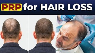 PRP Treatment For Hair Loss  Therapy Result  Skin Doctor Podcast  Click Entertainment [upl. by Moreville923]